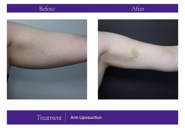 Arm Liposuction