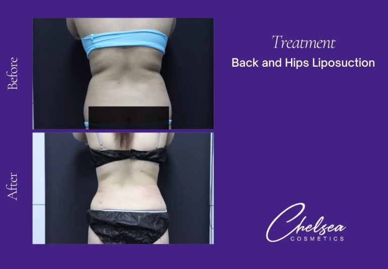 Liposuction before and after results — Chelsea Cosmetics Melbourne