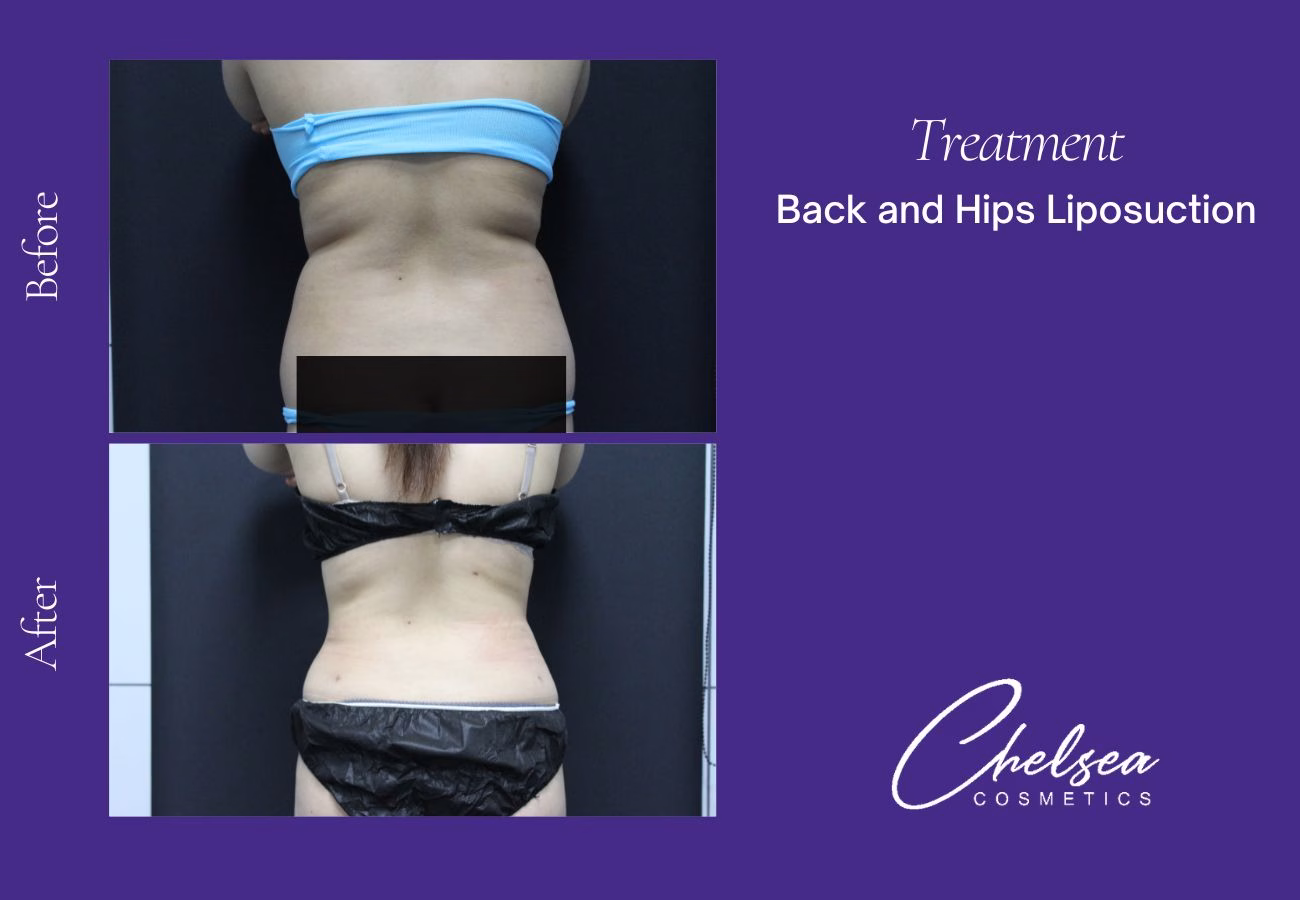 Liposuction before and after results — Chelsea Cosmetics Melbourne