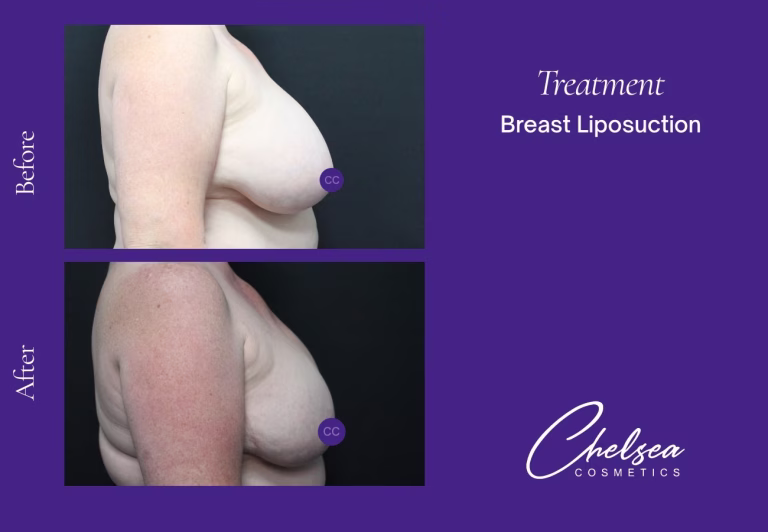 Breast Liposuction