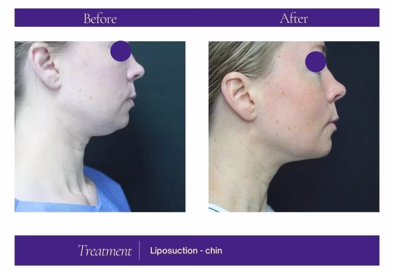 Chin Liposuction