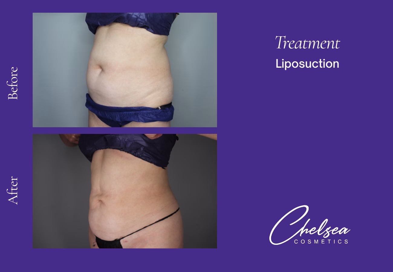 Liposuction — Chelsea Cosmetics Melbourne