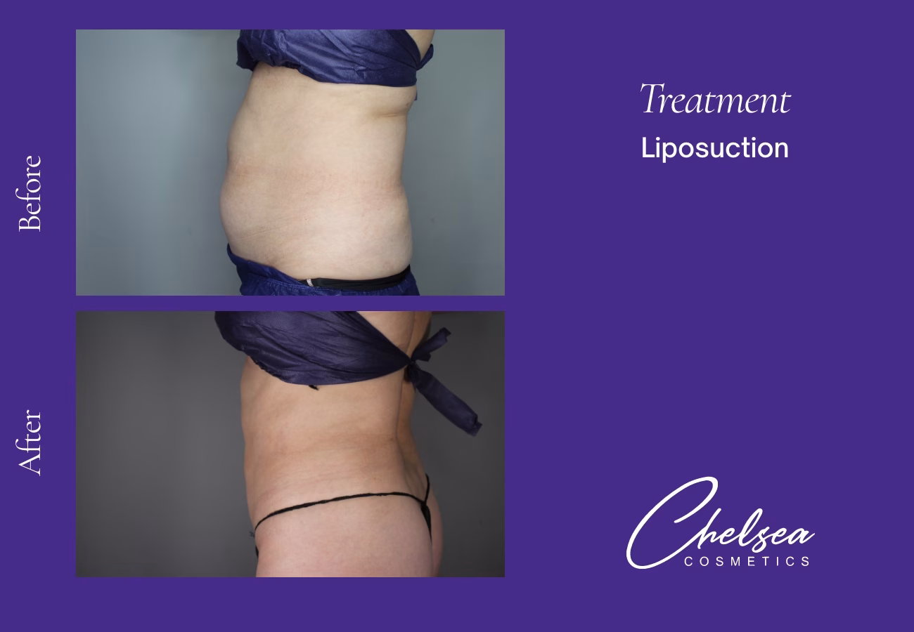 Liposuction — Chelsea Cosmetics Melbourne