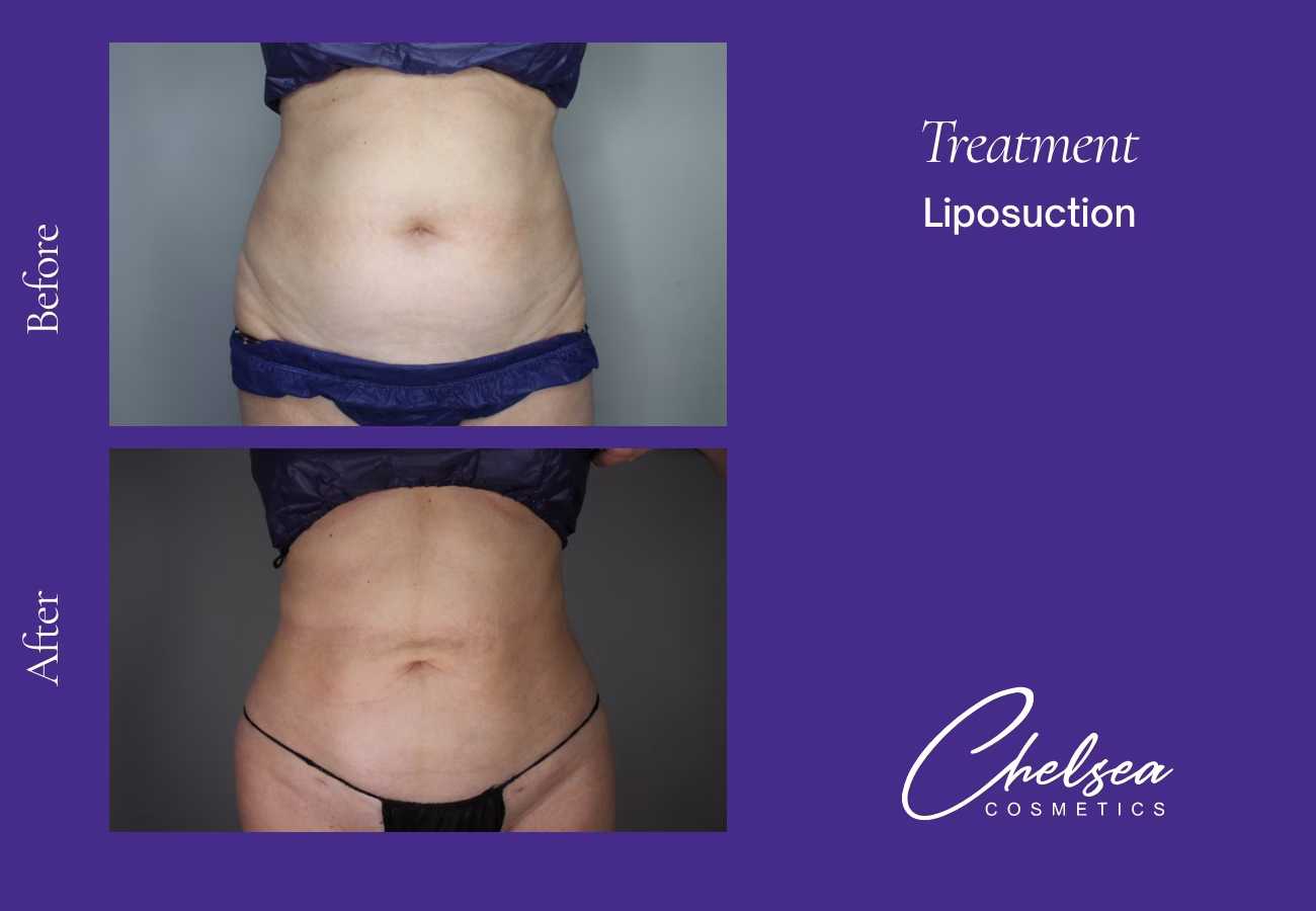 Liposuction — Chelsea Cosmetics Melbourne