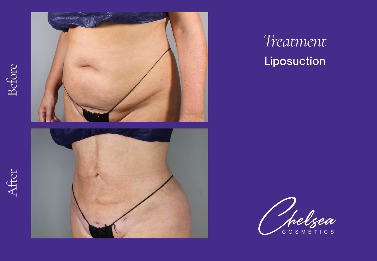 Liposuction — Chelsea Cosmetics Melbourne