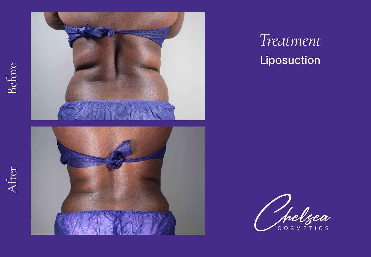 Liposuction before and after results — Chelsea Cosmetics Melbourne