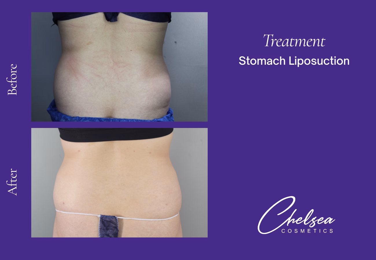 Stomach Liposuction before and after results — Chelsea Cosmetics Melbourne