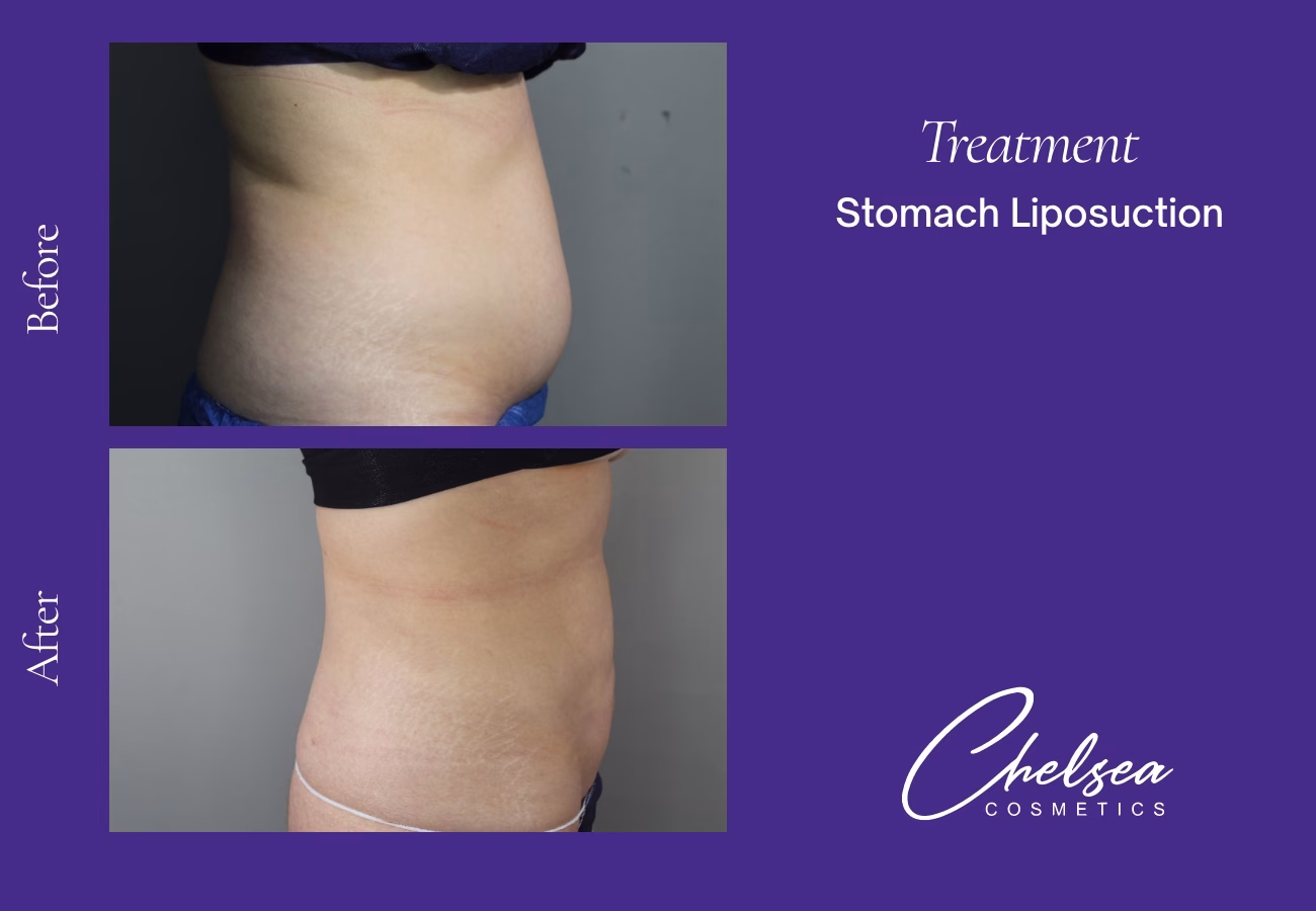Stomach Liposuction — Chelsea Cosmetics Melbourne
