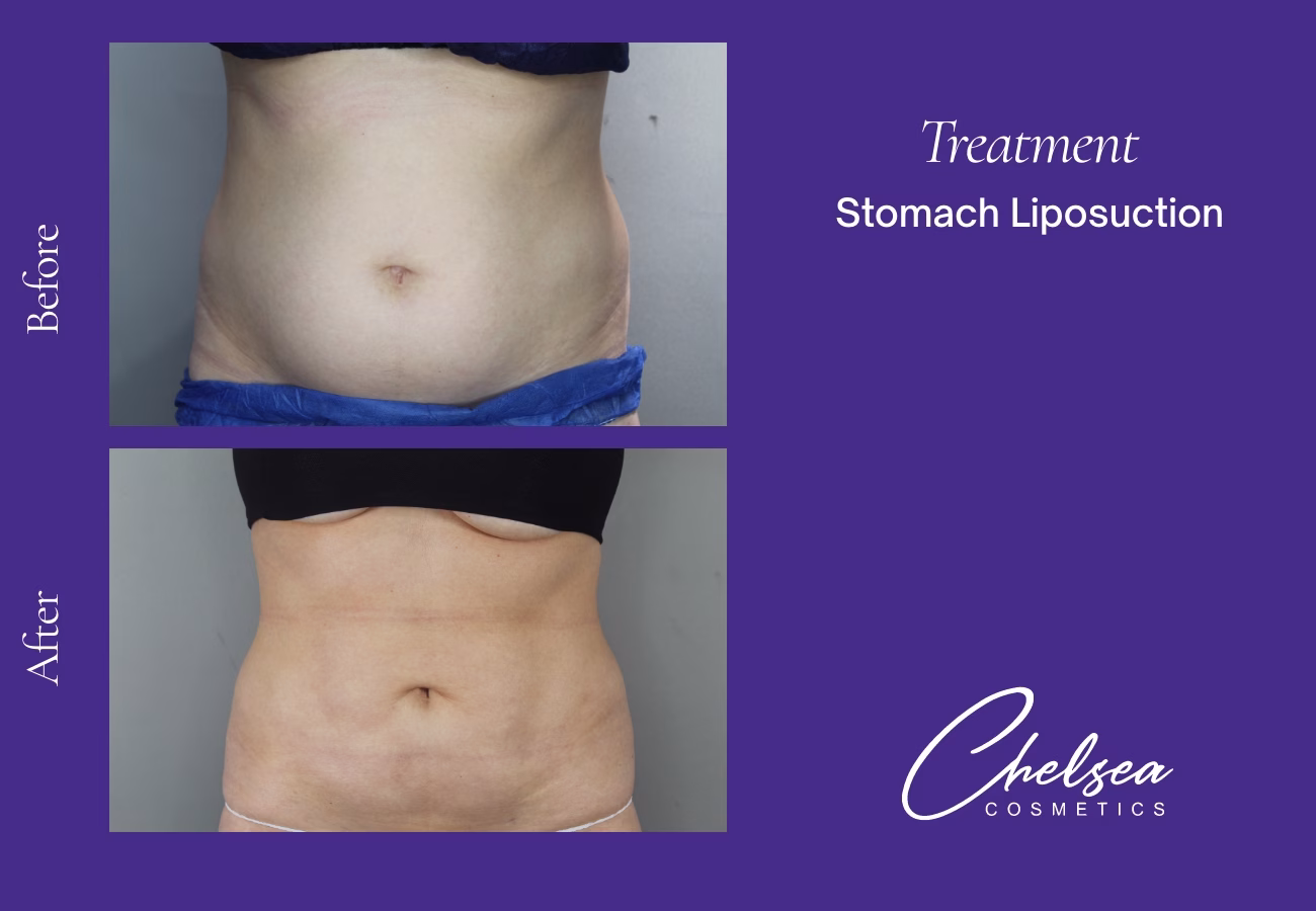 Stomach Liposuction — Chelsea Cosmetics Melbourne