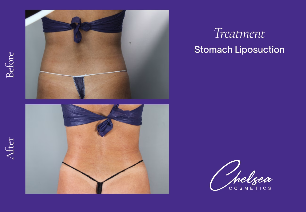Stomach Liposuction before and after results — Chelsea Cosmetics Melbourne