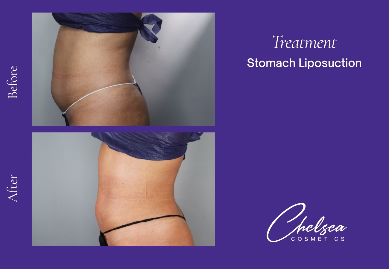 Stomach Liposuction — Chelsea Cosmetics Melbourne