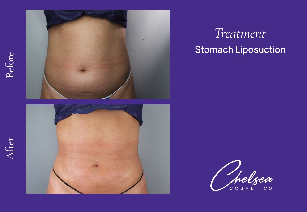 Stomach Liposuction — Chelsea Cosmetics Melbourne