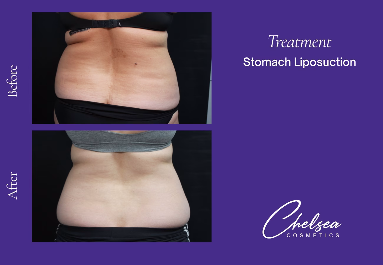 Stomach Liposuction before and after results — Chelsea Cosmetics Melbourne