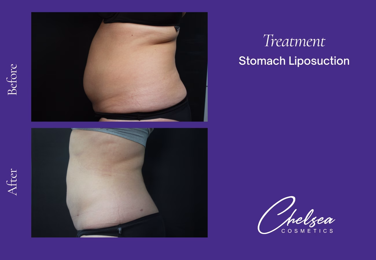Stomach Liposuction — Chelsea Cosmetics Melbourne