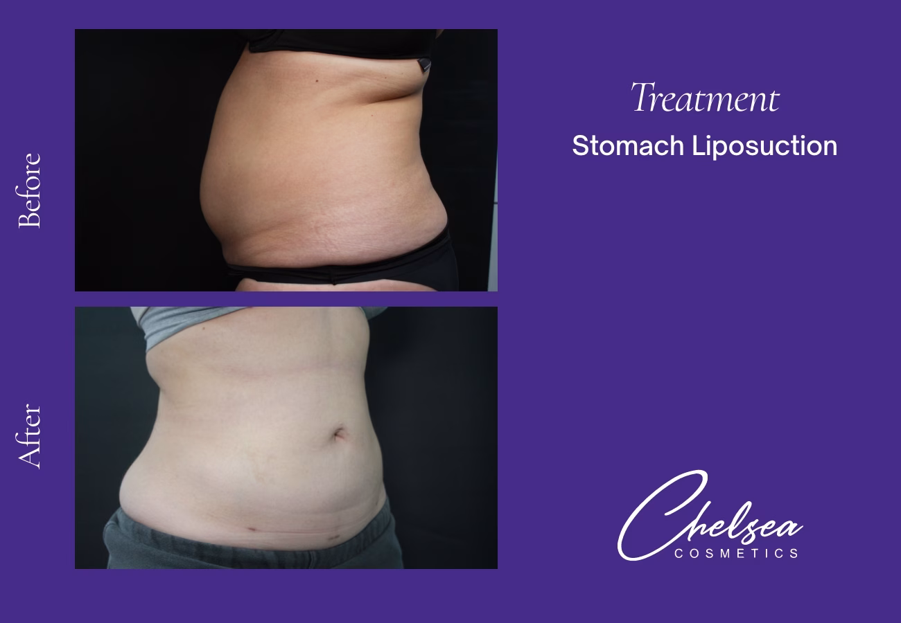 Stomach Liposuction — Chelsea Cosmetics Melbourne