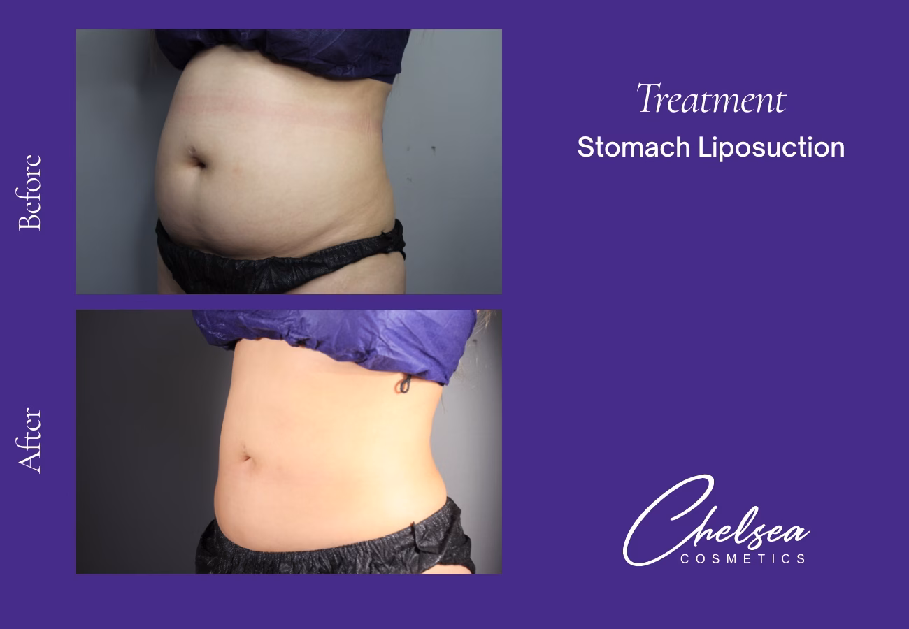 Stomach Liposuction — Chelsea Cosmetics Melbourne