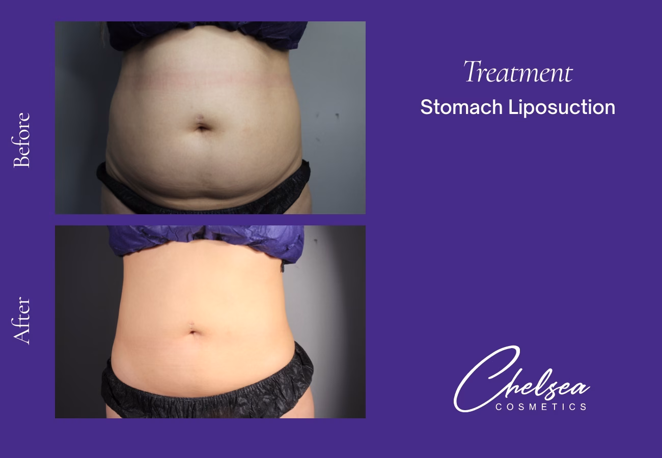 Stomach Liposuction — Chelsea Cosmetics Melbourne