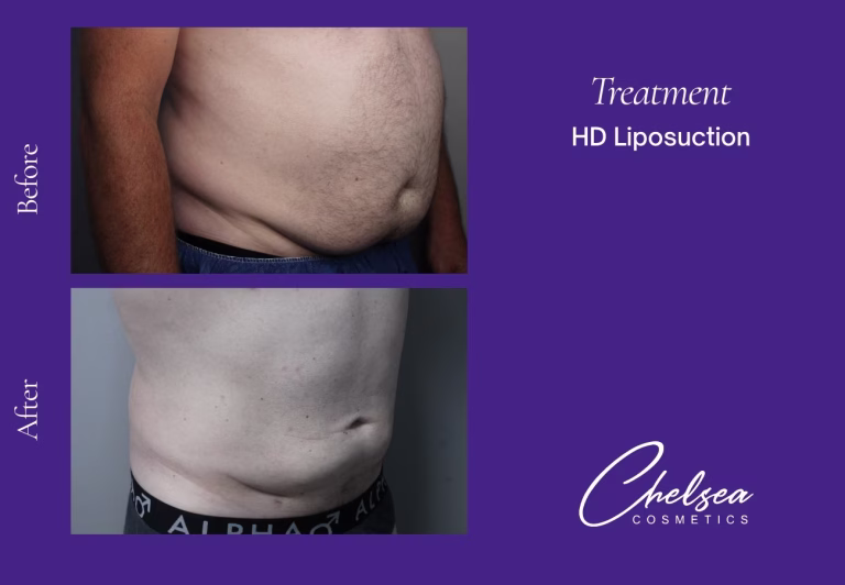 High-Definition Liposuction