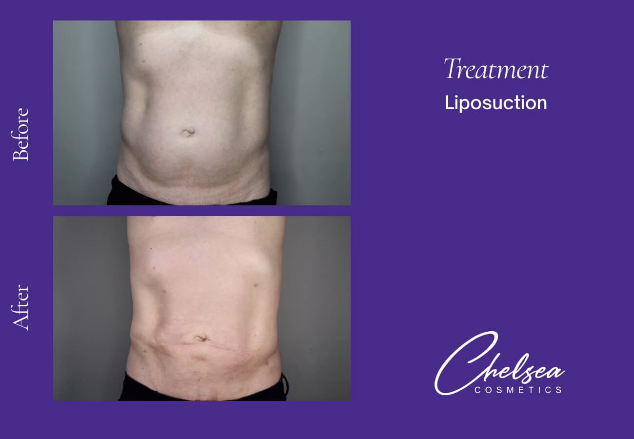 Liposuction — Chelsea Cosmetics Melbourne