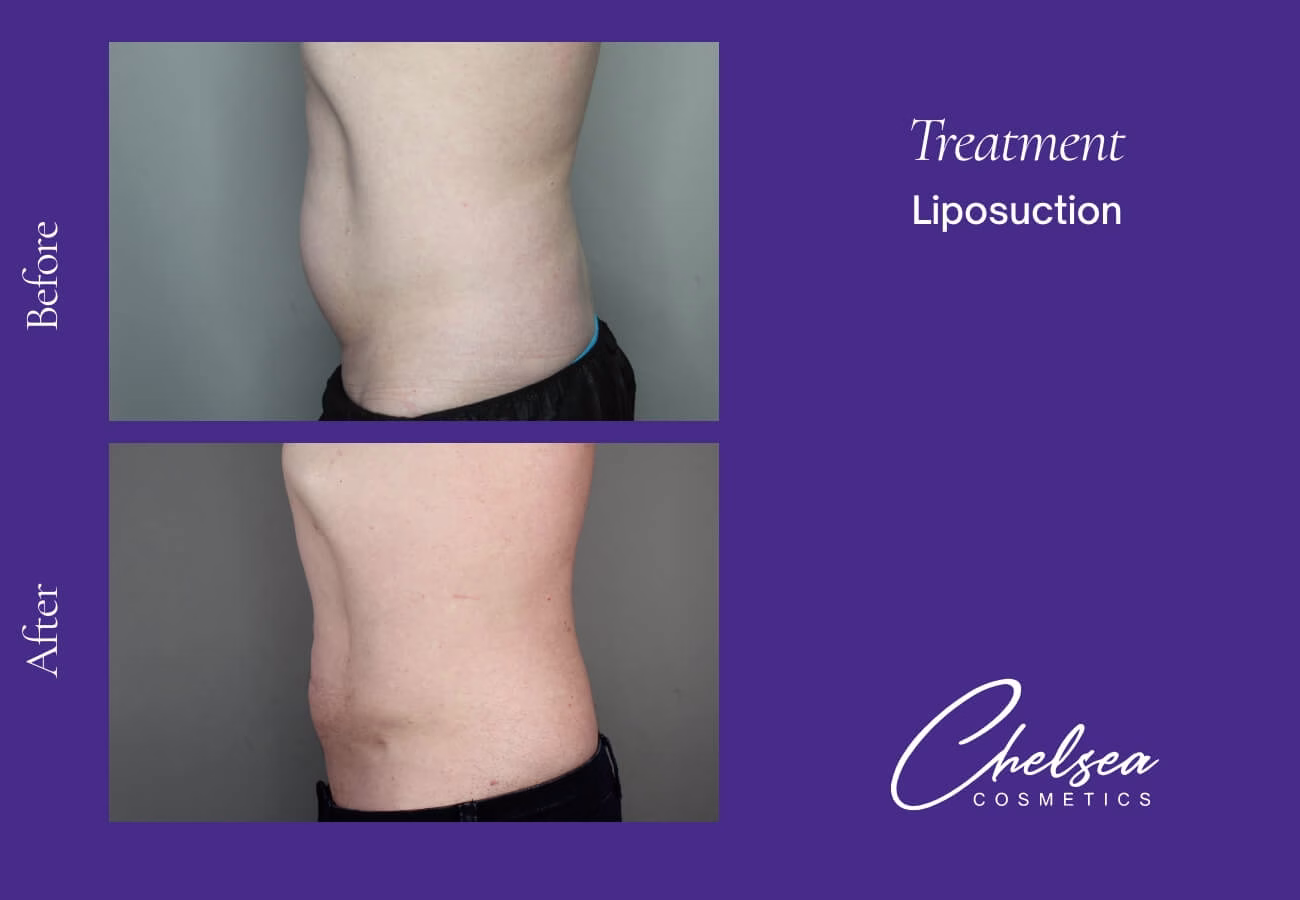 Liposuction — Chelsea Cosmetics Melbourne