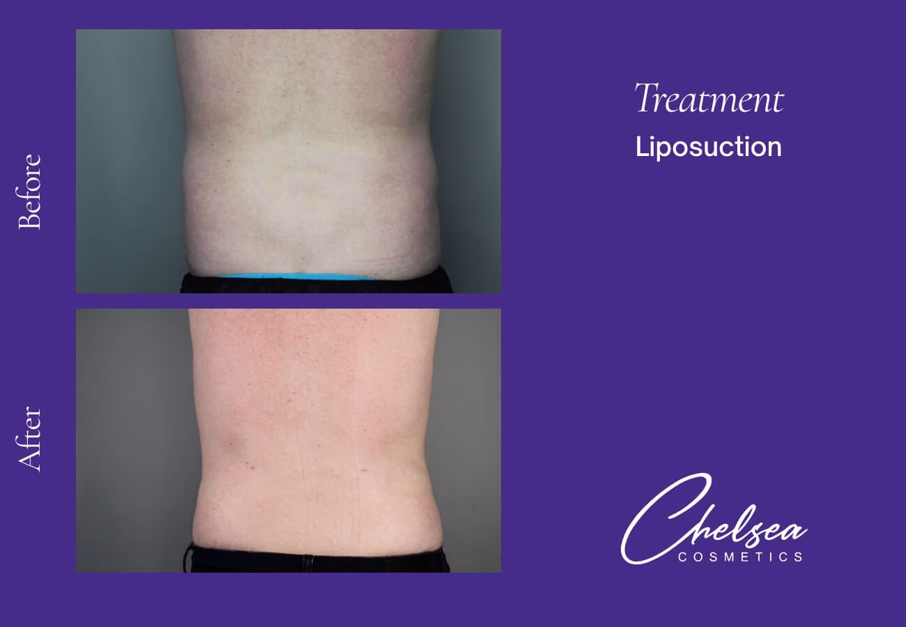 Liposuction — Chelsea Cosmetics Melbourne