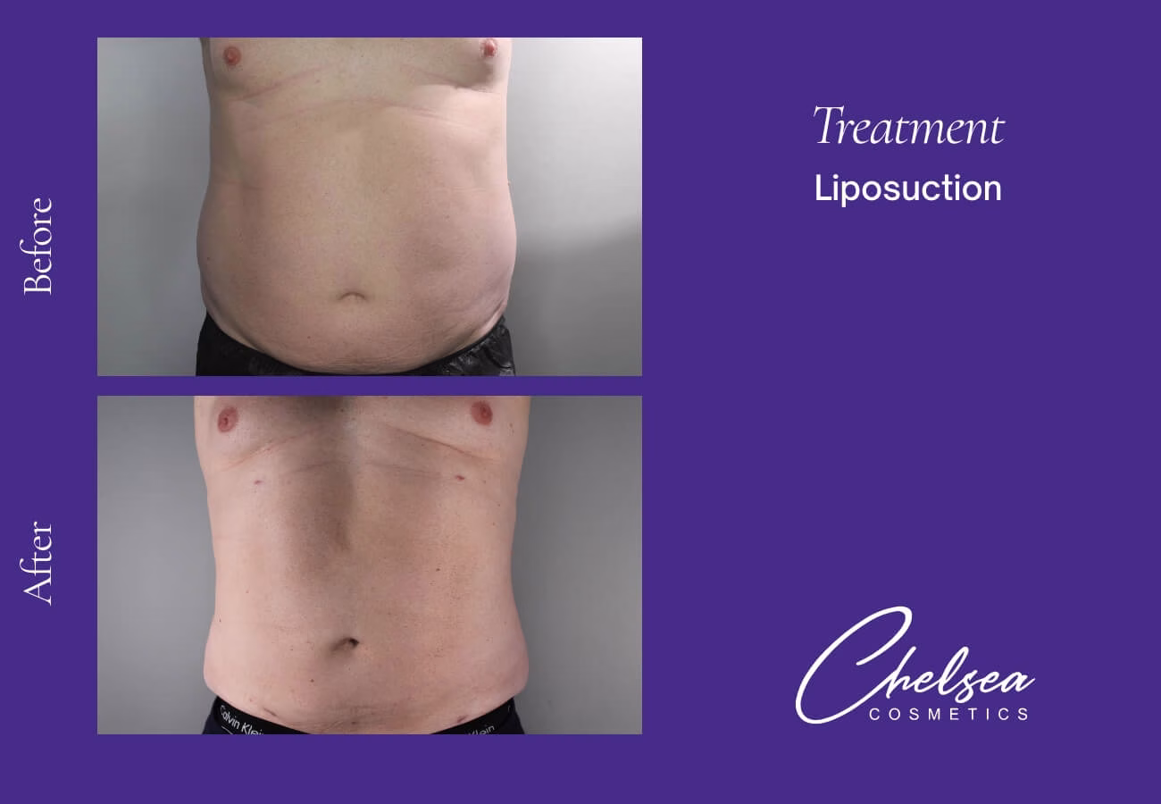 Liposuction — Chelsea Cosmetics Melbourne