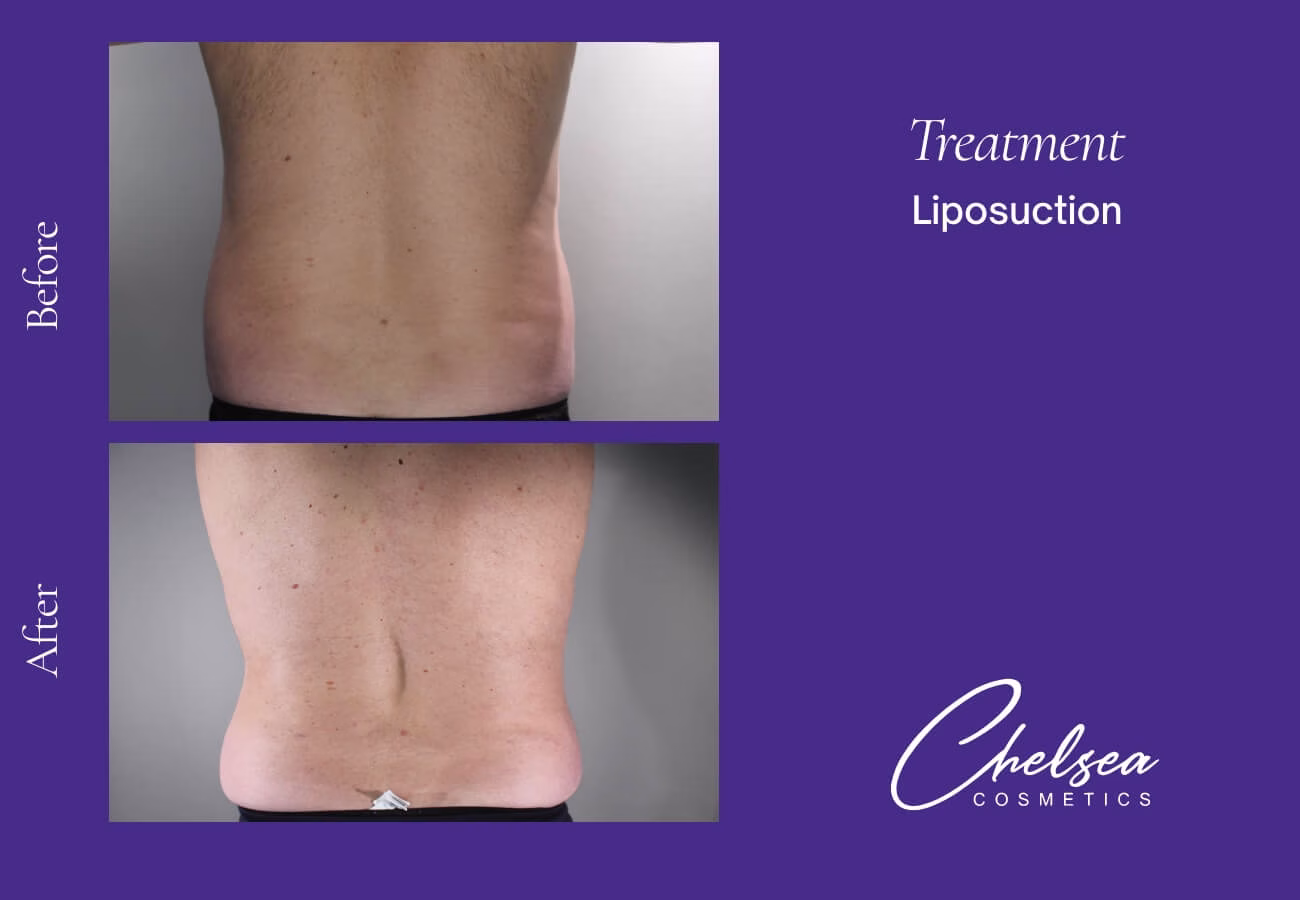 Liposuction — Chelsea Cosmetics Melbourne
