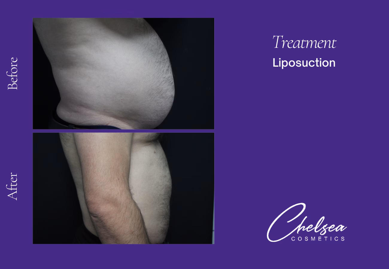Liposuction — Chelsea Cosmetics Melbourne