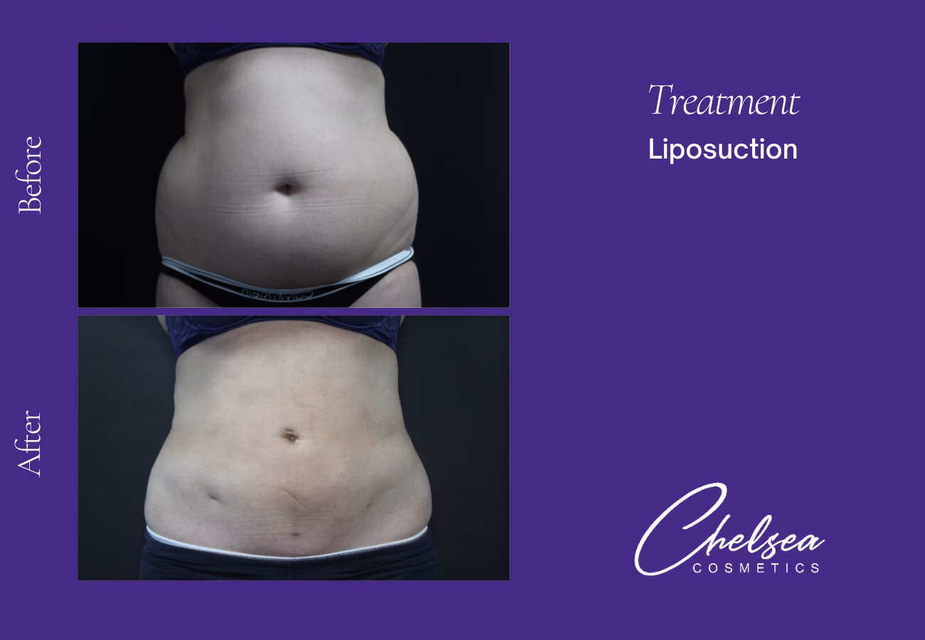 Liposuction — Chelsea Cosmetics Melbourne