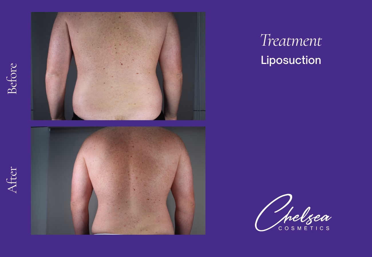 Liposuction before and after results — Chelsea Cosmetics Melbourne