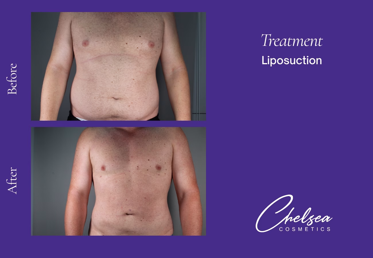 Liposuction — Chelsea Cosmetics Melbourne
