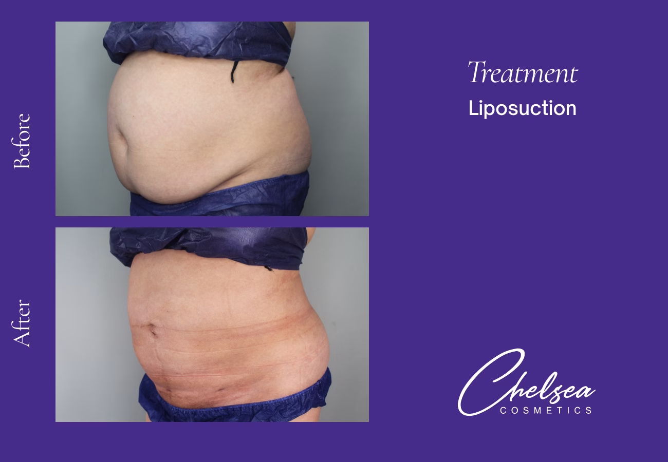 Marg abdomen tt — Chelsea Cosmetics Melbourne