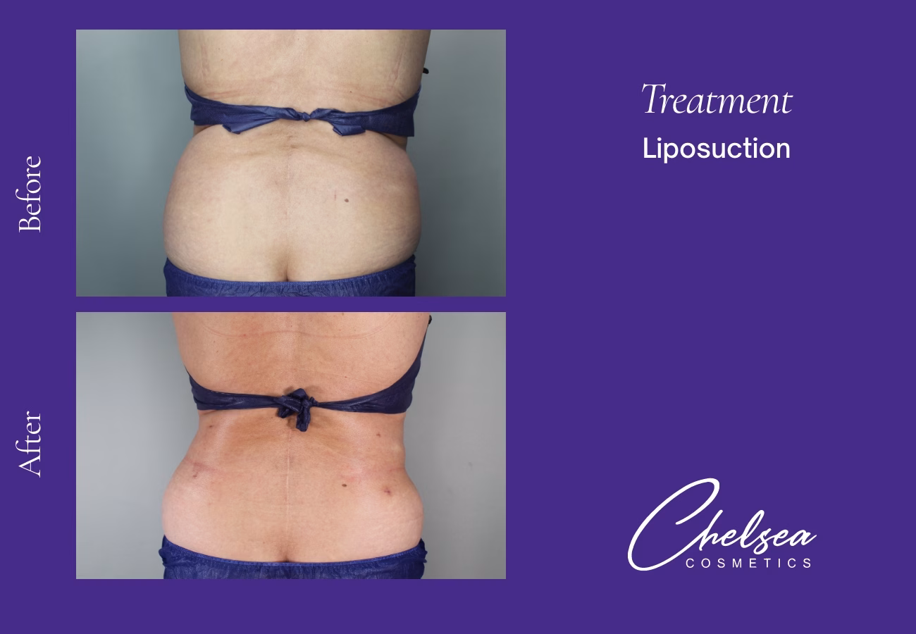 Marg abdomen tt — Chelsea Cosmetics Melbourne