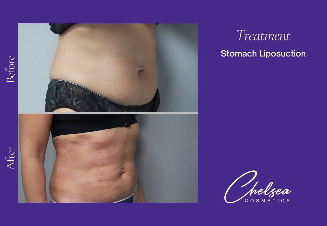 Liposuction — Chelsea Cosmetics Melbourne