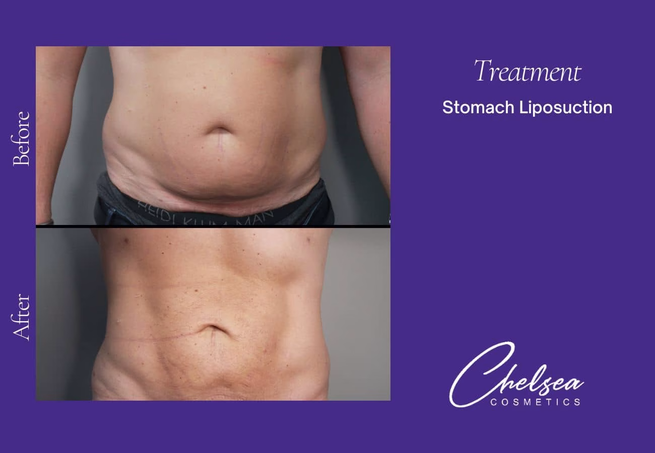 Liposuction — Chelsea Cosmetics Melbourne