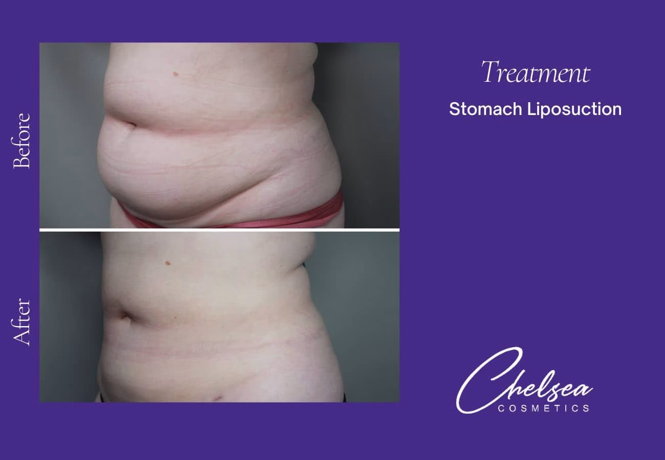 Liposuction — Chelsea Cosmetics Melbourne