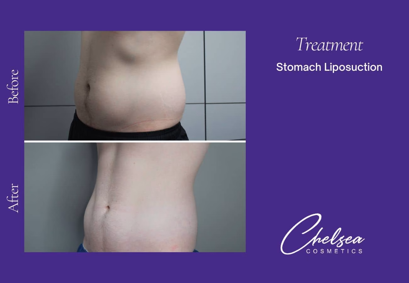 Liposuction — Chelsea Cosmetics Melbourne