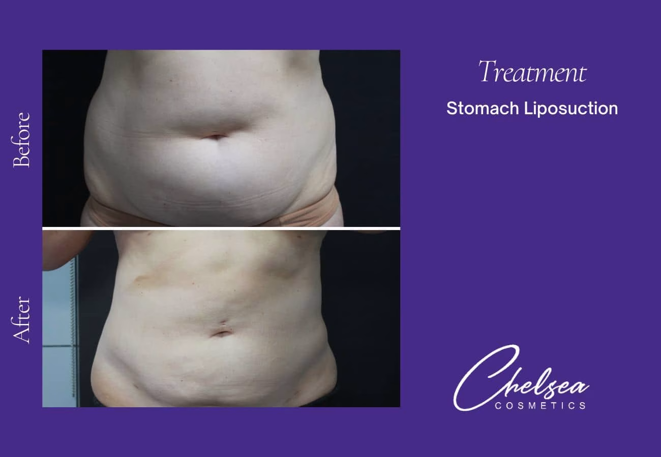 Liposuction — Chelsea Cosmetics Melbourne