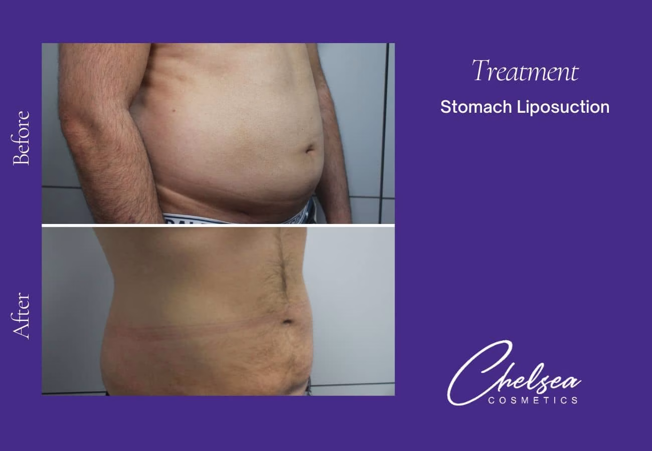 Liposuction — Chelsea Cosmetics Melbourne