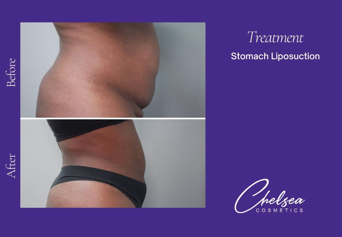 Liposuction — Chelsea Cosmetics Melbourne