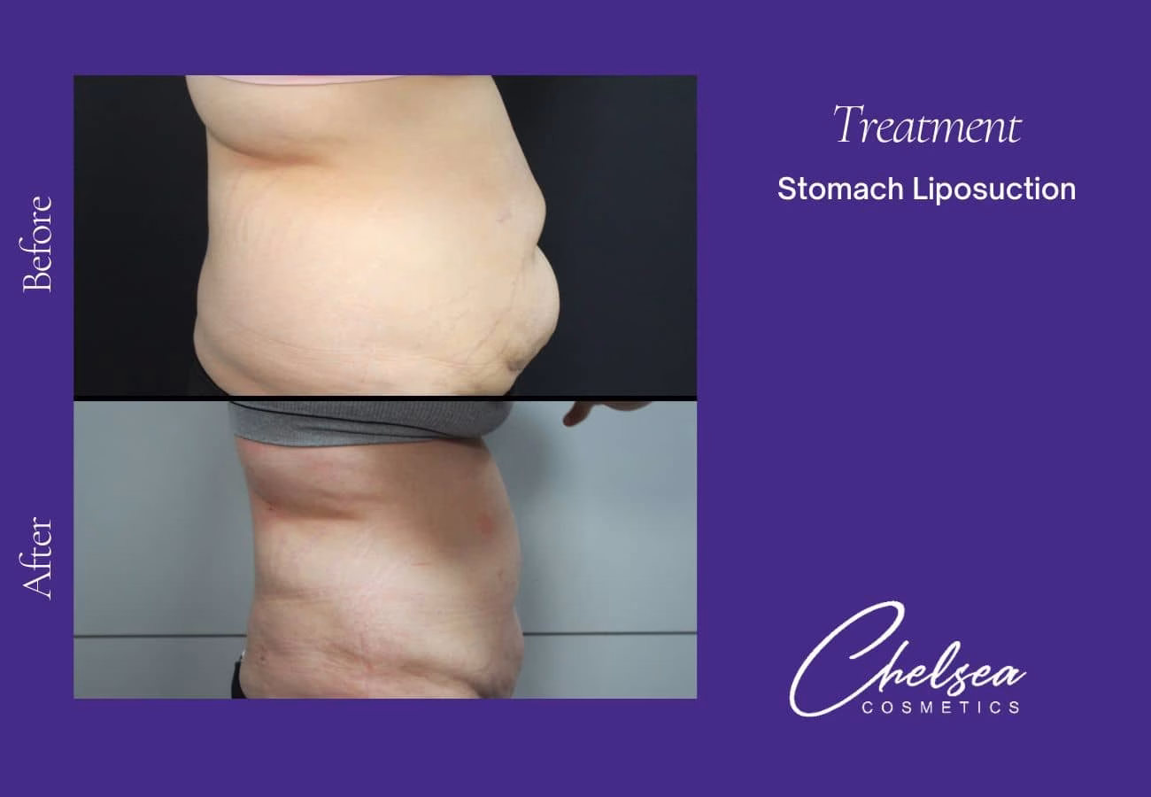 Liposuction — Chelsea Cosmetics Melbourne