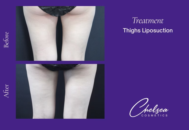 Thigh Liposuction
