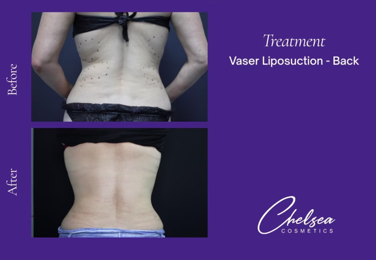 Vaser Liposuction